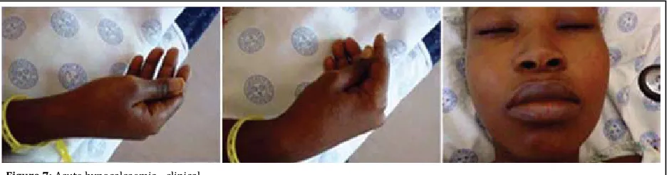 Figure 7: Acute hypocalcaemia - clinical
