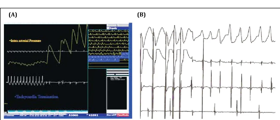Figure 3: (A) 55 yr old lady with dizziness. ECG shows RBBB with left axis with prolonged PR interval