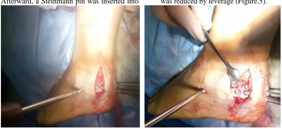 Fig. (5):  Minimally Invasive Plate Osteosynthesis (MIPO). 