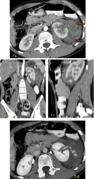 Fig 7)  AAST grade IV renal injury. A axial CT cut showing a large inhomogenously  hyperattenuated LT sided perinephric hematoma ( 5.5x6.7 cm) occupying the renal and perirenal spaces with posterior cortical deep laceration extending to the renal pelvis B 