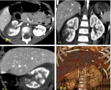 Fig 8)  AAST grade IV renal trauma managed conservatively. A: axial CT cut showing multiple non enhanced fragments of the RT kidney with perinephric hematoma