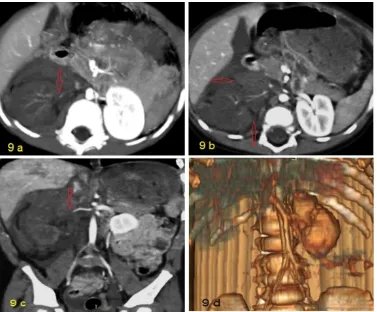 Fig 9)  AAST grade V renal injury. A&B: axial CT cuts reveals non enhanced right kidney as a consequence of Rt renal artery thrombosis with retrograde opacification of the renal vein from the inferior vena cava(arrow in a),.There are multiple parenchymal l