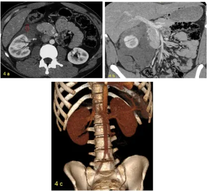 Fig 4)  AAST grade IV renal trauma. A: axial CT cut showing non enhanced anterior upper pole of the RT kidney with perinephric hematoma