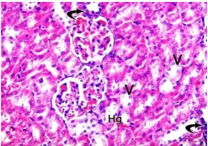 Fig. (3): A photomicrograph of cortex of a kidney in rats of methimazole treated group showing a corpuscle with shrunken glomerulus (G) and widened Bowman's space (S)