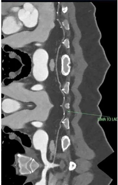 Fig. 5  Curved planar reformatted maximum intensity projection (MIP) image for the same case shows good contrast opacification along the SVG to OM graft and good opacification of the distal LCX (left circumflex artery)