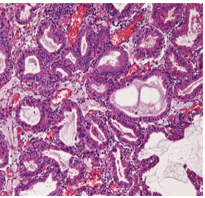 Figure 6. Histopathology of Cholesterol polyp. A polyp containing formy macrophages is seen