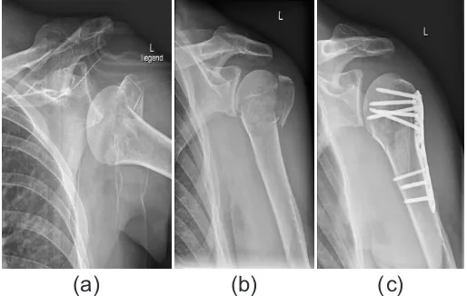 Figure 3: (a-c) Left shoulder: Dislocated (a), after reduction (b), post-operatively (c) (anterior-posterior views).