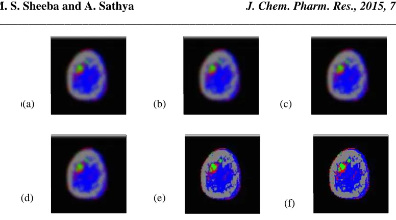 Figure 2: (a) Right breast MRI corrupted by Gaussian noise (b) Segmented Image by KFCM (c) Segmented Image by FCM based SVM  (d) Segmented Image by FCM-SVM (e) Segmented Image by KFCM -FSVM (f) Segmented Image by proposed method  