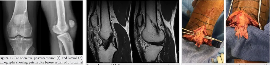 Figure 1: Pre-operative posteroanterior (a) and lateral (b) patellar tendon-bone autograft harvest for anterior cruciate medial, distal-lateral Z-type patellar tendon rupture after bone-radiographs showing patella alta before repair of a proximal ligament reconstruction.