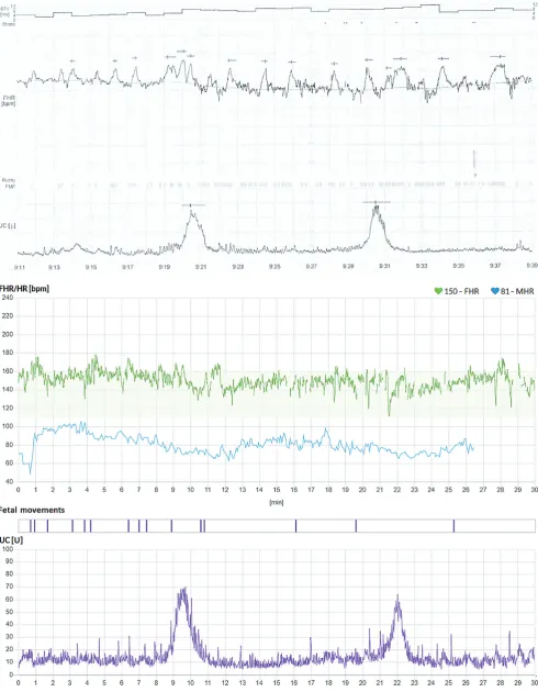 Fig. 3. A – pair of consistent recordings: upper – stationary device, lower – mobile device: upper – stationary device (suspicious), lower – mobile device (normal)