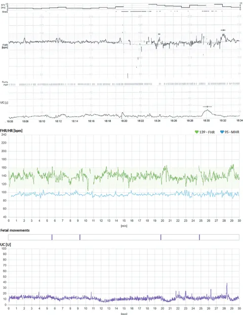 Fig. 3. B – pair of inconsistent recordings: upper – stationary device (suspicious), lower – mobile device (normal)