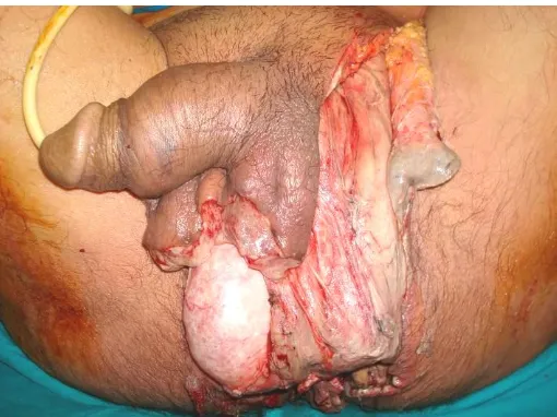 Figure (1) : Fournier' gangrene in 67 years male patient   