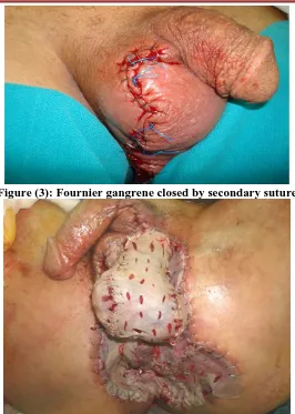 Figure (5): Fournier gangrene reconstructed by gracilis muscle flap.   