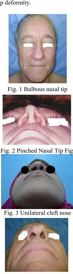 Fig. 3 Unilateral cleft nose 