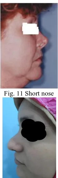 Fig. 11 Short nose 