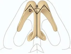 Fig. 13 Droopy nasal tip       The Majority of patients (70%) had been 