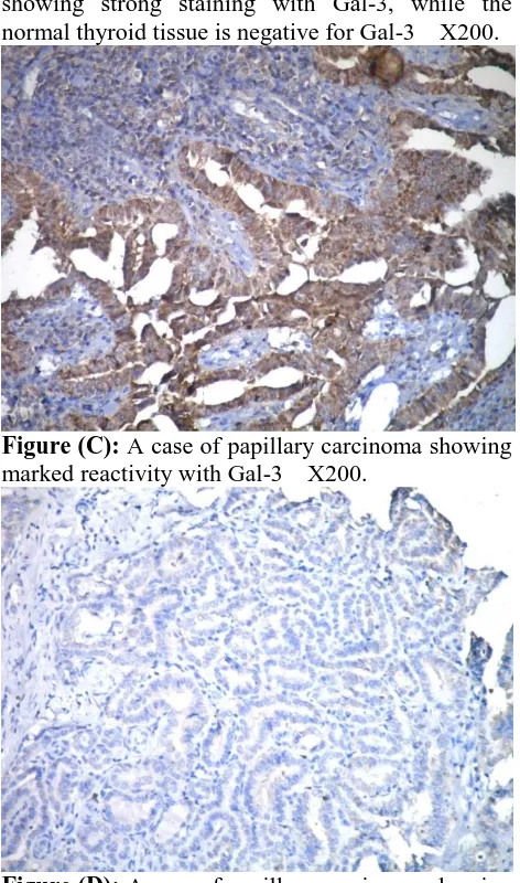 Figure (D):  A case of papillary carcinoma showing negative reactivity with TPO  X200