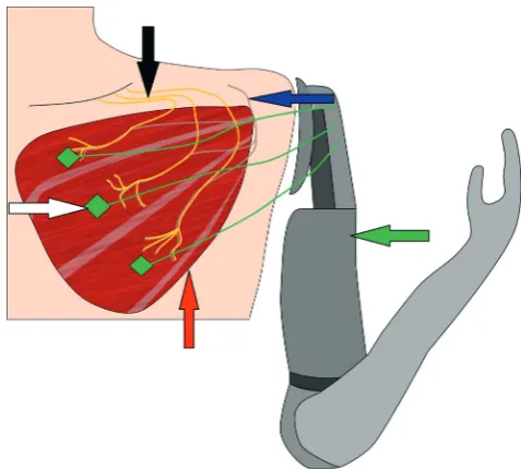 Fig. 5. Comparison of different types of peripheral nerve interfaces based on the level of signal selectivity and interface invasiveness