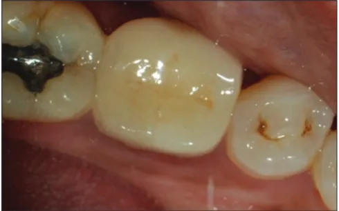 Figure 10: Ceramic endocrown cemented in 46