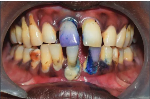 Figure 1: Anterior view of teeth after application of disclosing solution