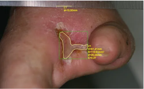 Fig. 3. Patient with diabetic foot ulcer (2 years) after amputation of right foot fingers II–IV – the topical state before the beginning of combined treatment including HBOT with evaluation wound dimensions by means of computerized planimetry; O – wound perimeter; S – wound surface; d – distance between maximally outlaying points on wound edge; C – wound circularity (near-circle level of wound shape with values 0–1, where 1 means circle) 