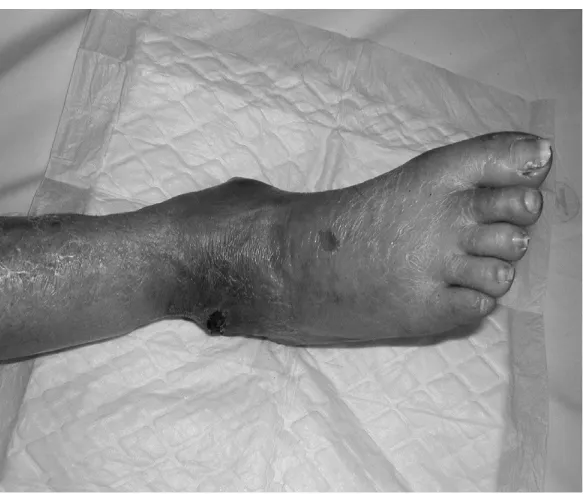 Figure 1: Foot deformity characteristic of established Charcot foot 