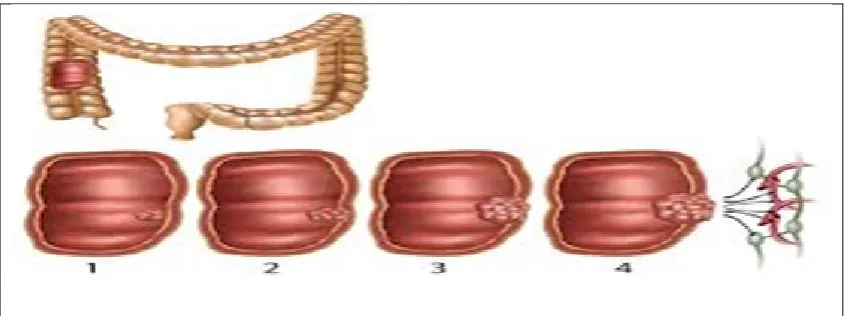 Figure 1.1: Colon cancer and polyp 