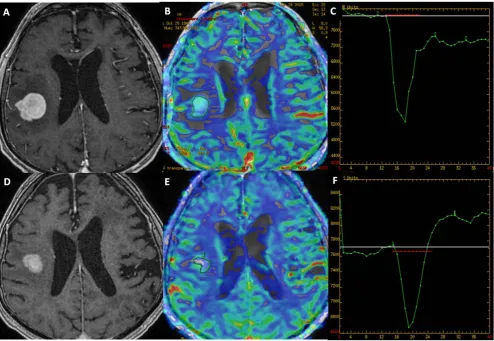 Fig. 3. A patient with a single CNSL lesion in the right parietal lobe examined with 2 DSC perfusion techniques with (A–C) and without (D–F) a preloading bolus