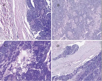 Figure 2. A:mous corpuscles. (hematoxylin-eosin, original magnification ×100), C: Show the mucoid degeneration in tumor interstitial (hematoxylin-eosin, original magnification ×100), D: Show the vascular invasion (hematoxylin-eosin, origi The tumor was cle