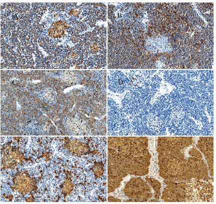 Figure 3. The tumor cells were positive for Cytokeratin(pan) A, Syn B and CgA C (Original magnification ×200)