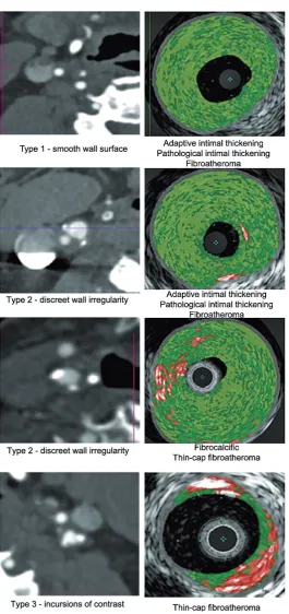 Table 5. Number of different morphological types of atherosclerotic plaque (IVUS-VH) correlated with de Weert classification types (DSCT)