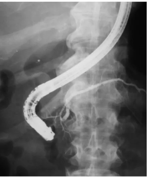 Fig. 2. Main pancreatic duct dilatation in its proximal part projecting onto the common bile duct