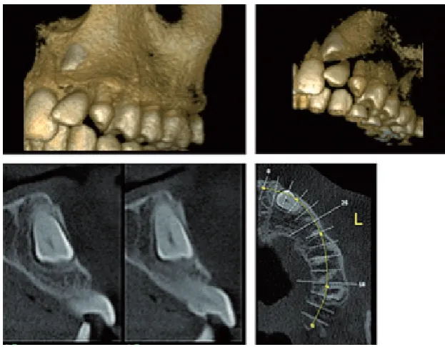 Fig. 1. 18-year old boy with impacted, transposed maxillary left canine, positioned close to the midline, and with mesially angulated, impacted teeth: 38, 48 and missing two lower incisors: A – panoramic view