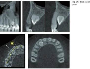 Fig. 2. 15-year old boy with palatally impacted maxillary right canine: A – panoramic view