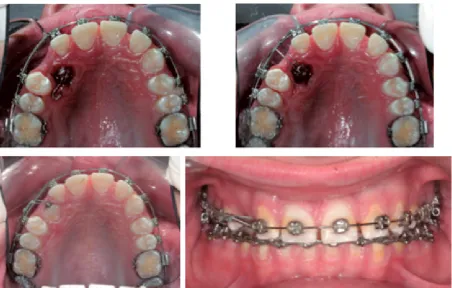 Fig. 2D. First surgical exposure (closed eruption technique) performed by Prof. Arye Shteyer