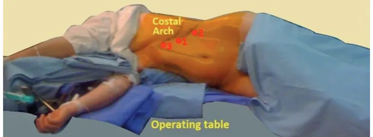 Fig. 2. Patient positioning for left adrenalectomy using posterior retroperitoneal approach (PRA); 1, 2, 3 – trocar sites in the range of their introducing