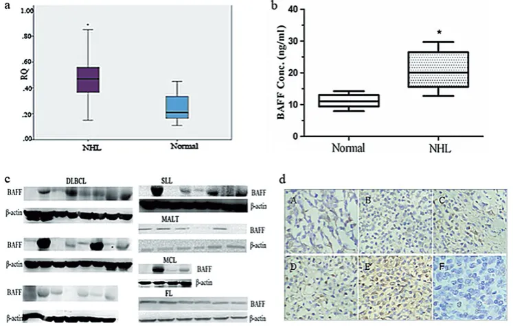 Fig. 1. BAFF expression in the peripheral blood and tumor tissue of NHL patients: a) BAFF mRNA expression in the PBMCs of NHL patients and healthy controls; b) BAFF protein expression in the serum of NHL patients by ELISA; c) BAFF protein expression in the PBMCs of NHL patients by Western blot; d) BAFF expression in NHL subtypes by immunohistochemistry: A – diffuse large B cell lymphoma (DLBCL); B – follicular lymphoma (FL); C – mantle cell lympho-ma (MCL); D – small lymphocytic lymphoma (SLL); E – mucosa-associated lymphoid tissue (MALT); F – normal tissue