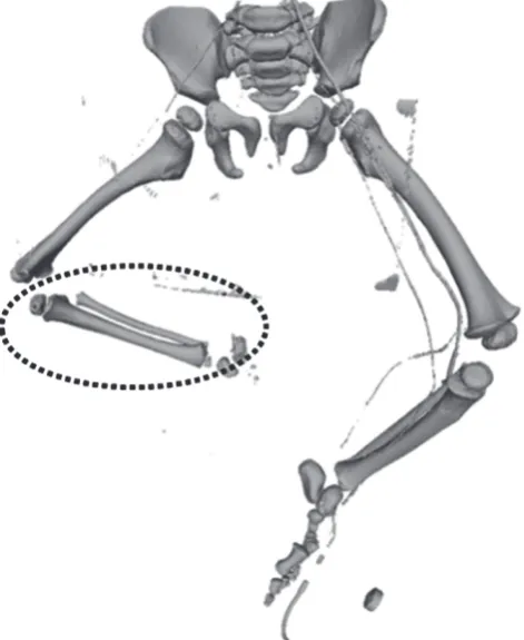 Fig. 1. Tibia and fibula extracted from computed tomography data
