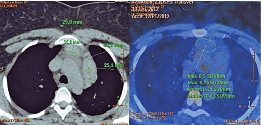 Fig. 1. A comparison of computed tomography (CT) and positron emission tomography (PET-CT) results in Hodgkin lymphoma patient after completion of chemotherapy