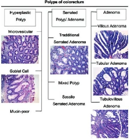 Fig. 1. Types of colon polyps