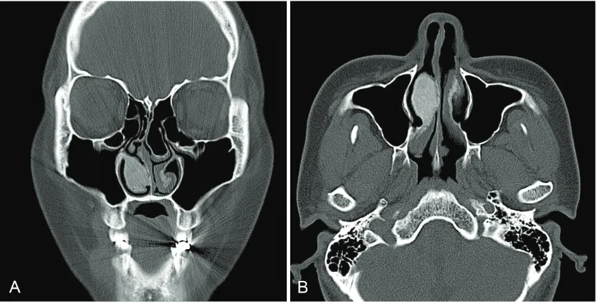 Figure 1. Preoperative computed tomography scan. Both coronal (A) and axial (B) planes show hypertrophied right inferior turbinate with ground-glass appearance, compatible with fibrous dysplasia