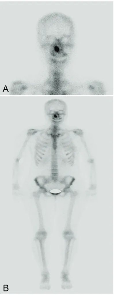 Figure 2. Preoperative bone scan. Whole body bone scan (A and B) shows hot uptake in the right inferior turbinate in otherwise normal study.