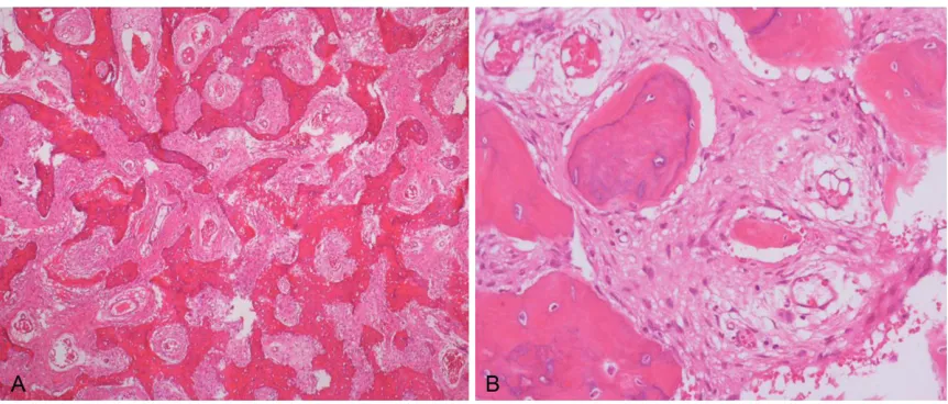Figure 3. Histologic examination. Microscopic finding demonstrates woven bone formation, surrounding fibrous stroma without osteoblastic rimming and irregular Chinese character-like bony trabeculae