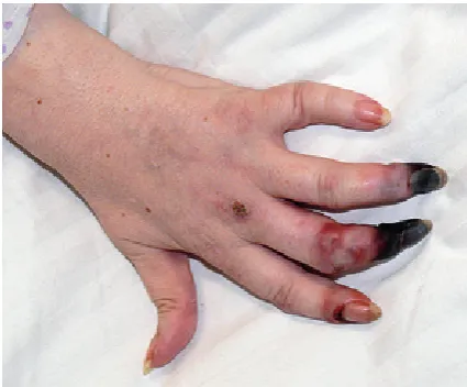 Fig. 7. Fingertip ulceration in a 35-year-old patient with diffuse systemic sclerosis