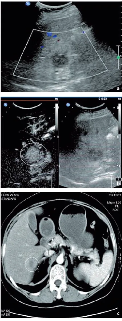 Fig. 1. Small liver cancer: A – conventional ultrasound enhancement in arterial phase (white circle) and the liver, unclear boundary (white arrow) and no blood flow signal; B – CEUS showed diffuse enhancement within 18 s (white circle); C – CECT displayed non-showed a 1.0 0.9 cm isoecho in the right lobe of the liver abscess was considered