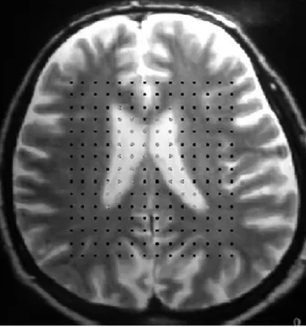 Fig. 1. Axial MRI scan of a human brain with a transparent test system superimposed. For the Cavalieri estimate of total ventricular volume every point that hit the ventricle was counted as a Pi