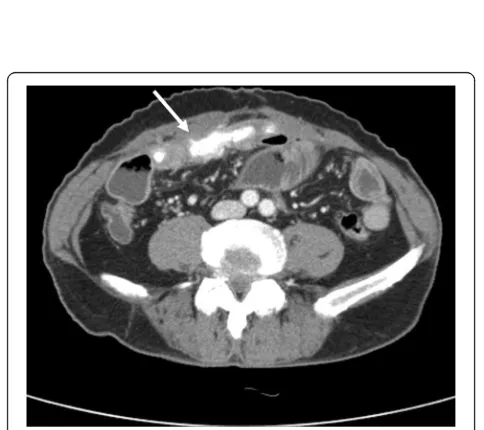 Fig. 4 A localized high density material (arrow) in the abdominalcavity was presented in abdominal CT