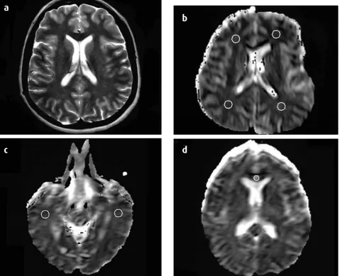 Figure 1: Axial T2-weighted image shows white matter areas that do not include focal hyperintensities (a)