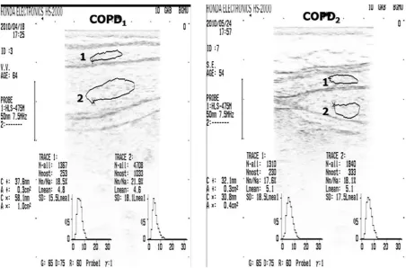 Fig. 2. Echodensitometric data of external (1) and internal (2) oblique abdominal muscles in patients with cOPD1,2