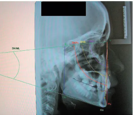 Fig. 1. A compilation of various analyses of a lateral cephalogram of one of the examined patients (S – the sella point; N – the nasion point; A – the subspinale; B – the supramentale; Po – the pogonion point; Me – the menton point; Go – the gonion point; SN – the line of the anterior cranial fossa; ML – the contiguous line to the lower edge of corpus of the mandible; SNA – the angle between the lines joining points S to N and N to A; SNB – the angle between the lines joining points S to N and N to B; SNPo – the angle between the lines joining points S to N and N to Po; ANB – the angle between the lines joining points A to N and N to B; WITS – the measure-ment defined by the projection of points A and B onto the occlusal plane FOL; ML:SN – the angle between planes ML and SN; SGo:NMe – the proportional relation of the back facial height to the front facial height)